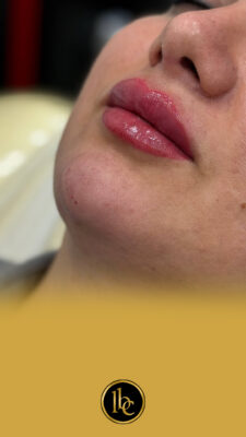 تزریق فیلر لب