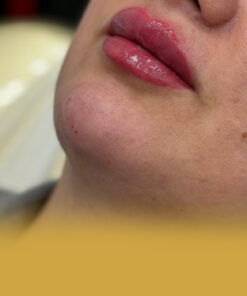 تزریق فیلر لب