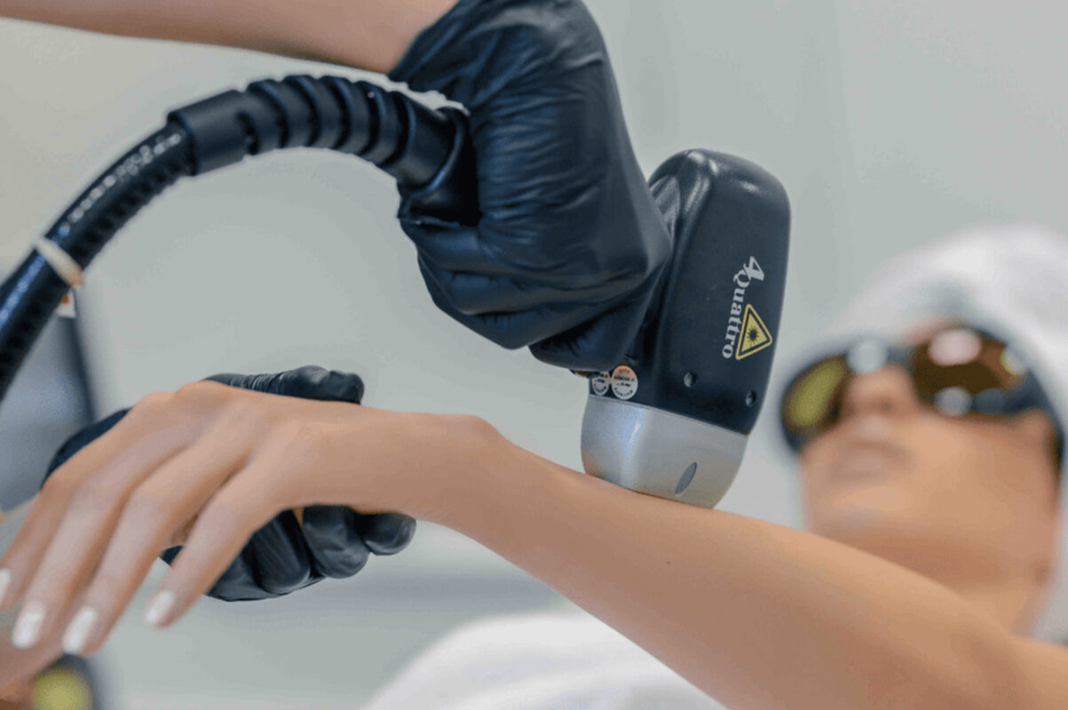 لیزر موهای زائد